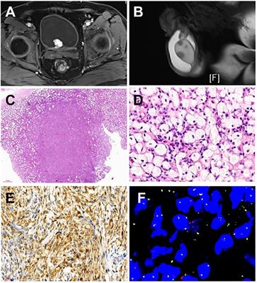 Case report: Systemic presentation of ALK-positive Histiocytosis